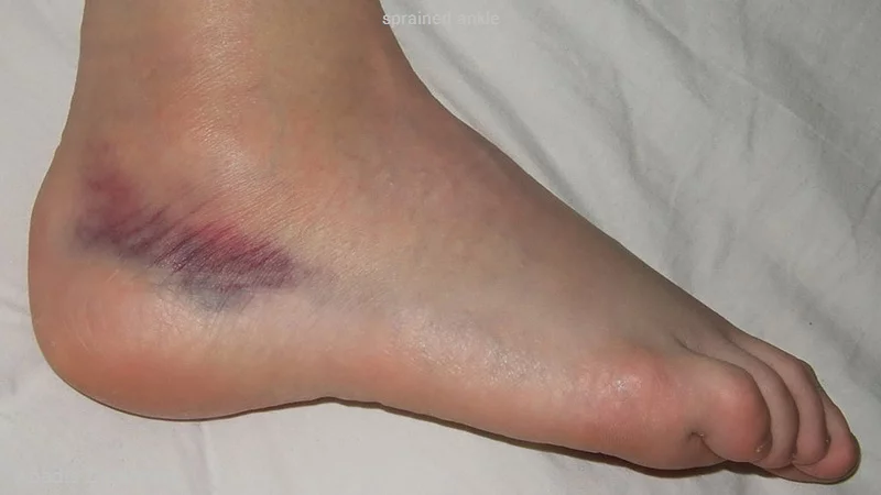sprained ankle